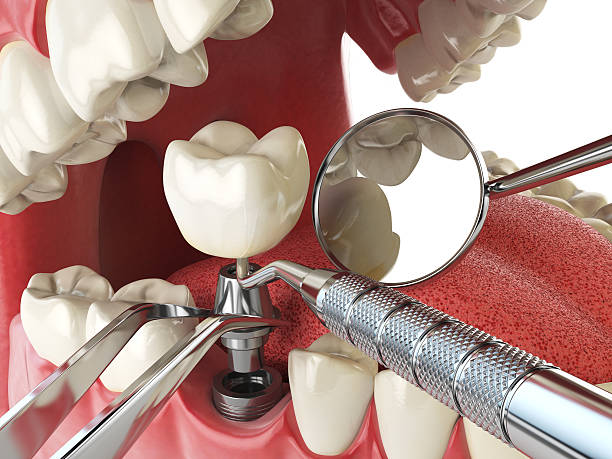 Best Lost Filling or Crown Replacement in Dormont, PA